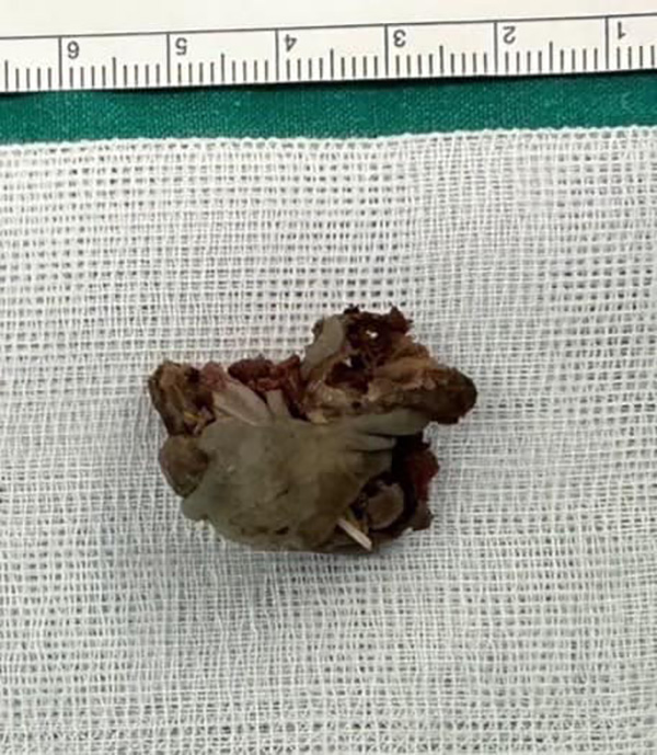 อุทาหรณ์ กินแกงนกสับจนติดคอ