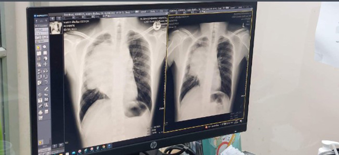 ป่วยเป็นมะเร็งปอดในวัย 24 ปี ทั้งที่ไม่ดื่มเหล้า ไม่สูบบุหรี่ ไม่เที่ยวกลางคืน