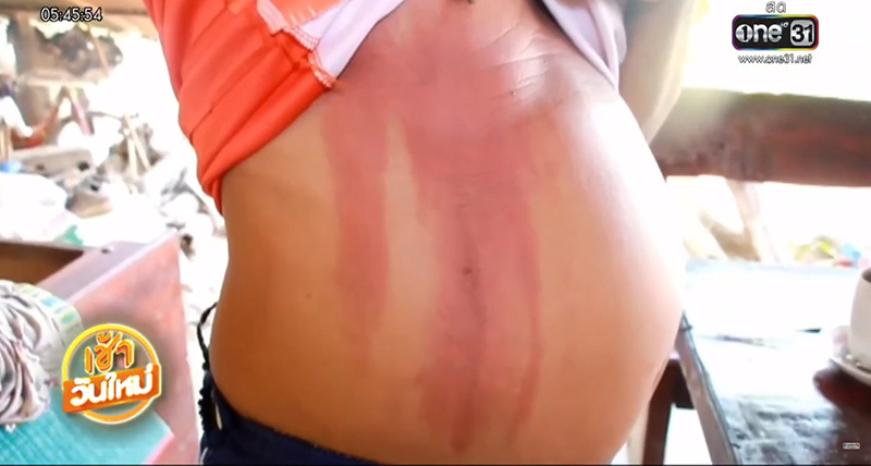 กดน้ำร้อนจากกระติก ไม่ทันใจใช้ถ้วยตัก ภัยร้ายแบบไม่คาดคิด