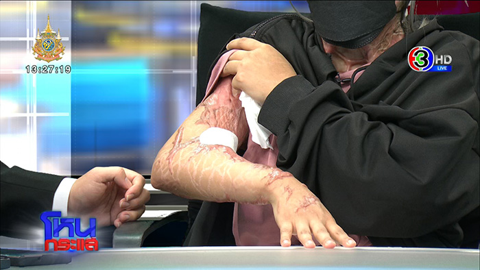 เมียเก่าใจโหด บุกสาดน้ำกรดสาวมอญ ลูก