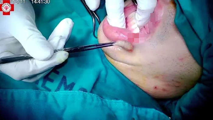 สะพรึง ชายปากบวมหลังเที่ยวป่า