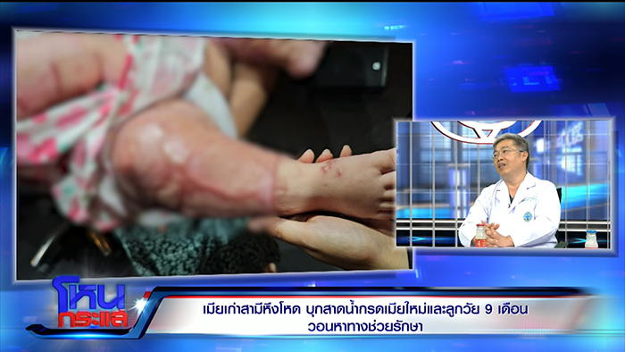 เมียเก่าใจโหด บุกสาดน้ำกรดสาวมอญ ลูก