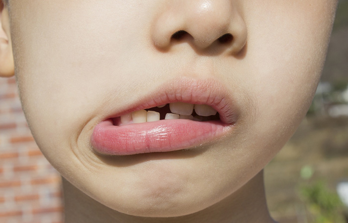 โรค Bell s palsy