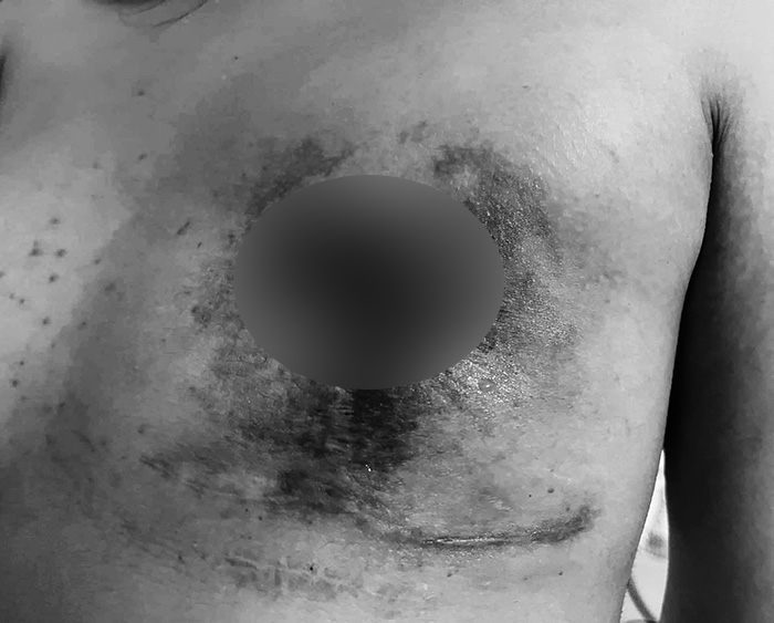 ฉาววงการศัลยกรรม สาวยกกระชับหน้าอก ติดเชื้อ