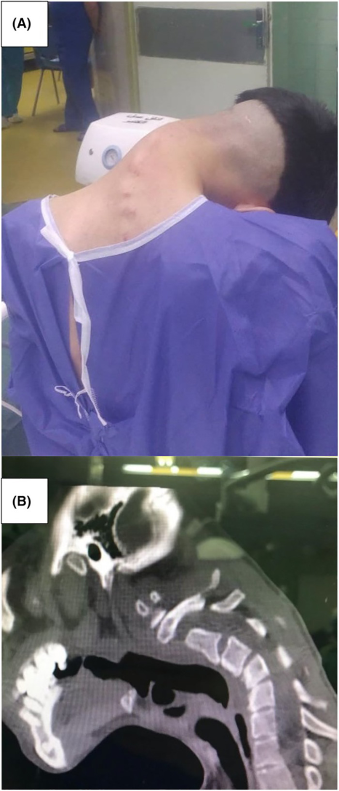 เปิดเคสหนุ่ม 23 หัวตก คอพับ 90 องศา