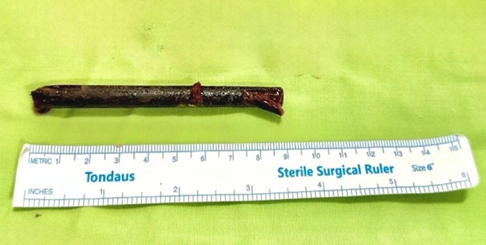 เคสประหลาด ปวดตาไปหาหมอ เจอตะเกียบไม้หัก 9 ซม