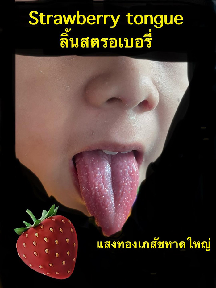 พ่อพาลูก 10 ขวบลิ้นสตรอว์เบอร์รีมาให้ดูว่าเป็นอะไร