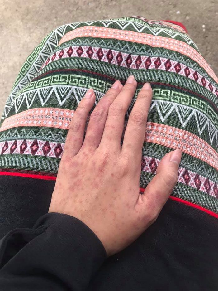 ภูมิคุ้มกันเป็นพิษ