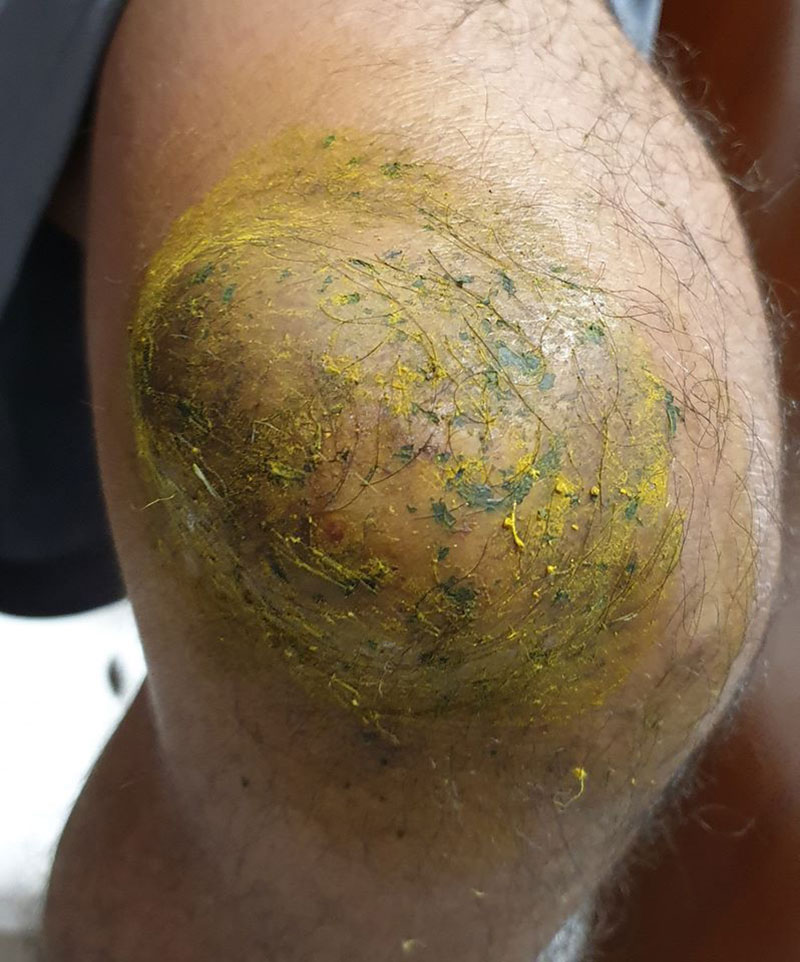 เข่าบวมมีหนอง 