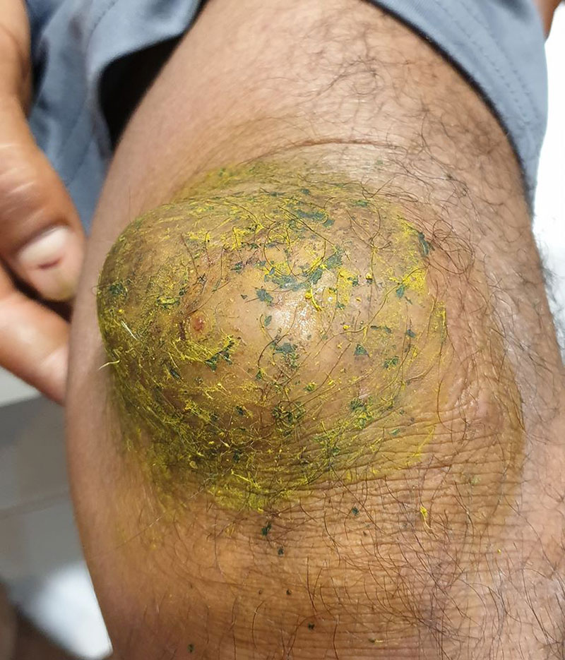 เข่าบวมมีหนอง 