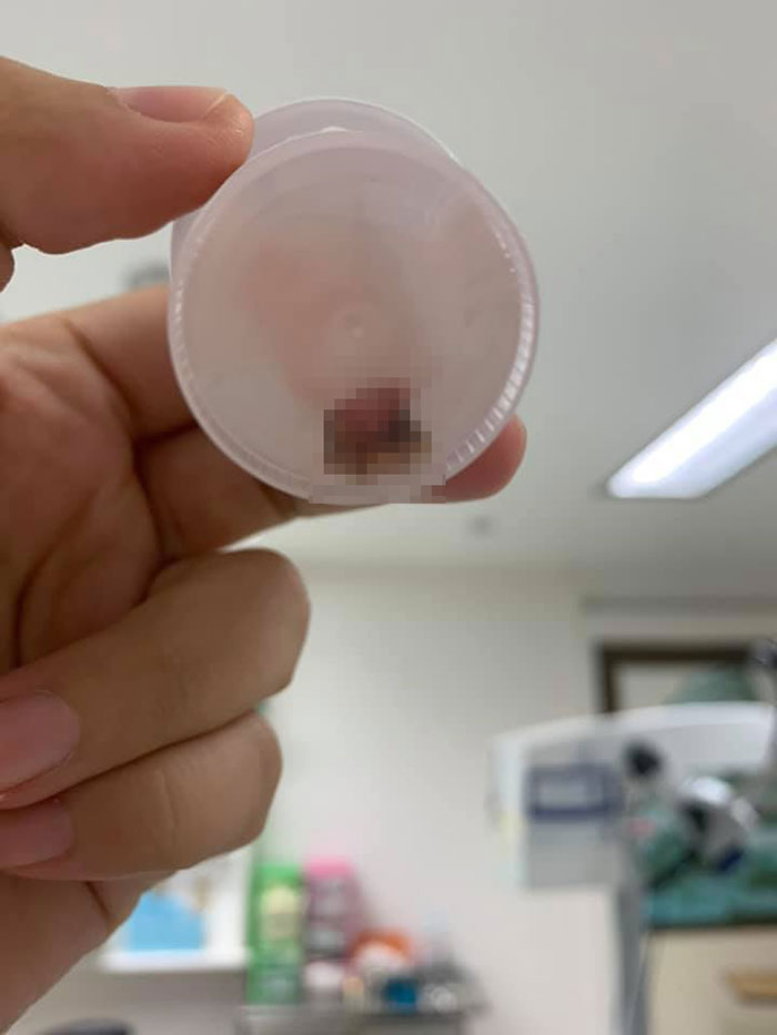 สาวพบพยาธิ