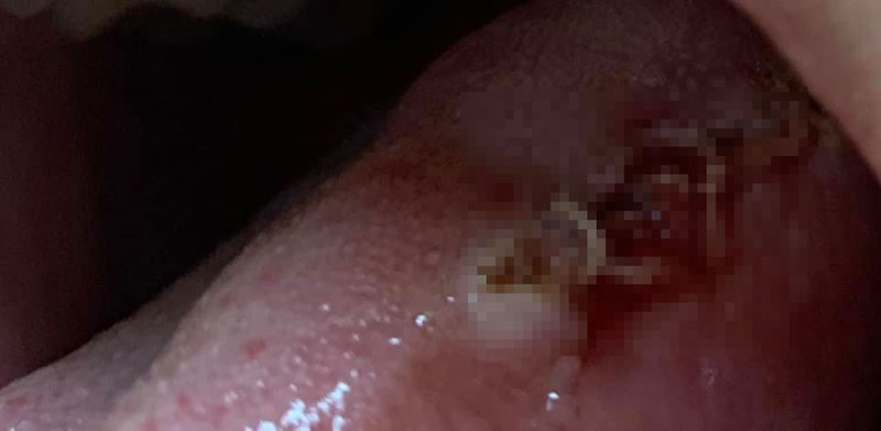 สาวพบพยาธิ