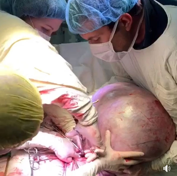 เนื้องอกยักษ์