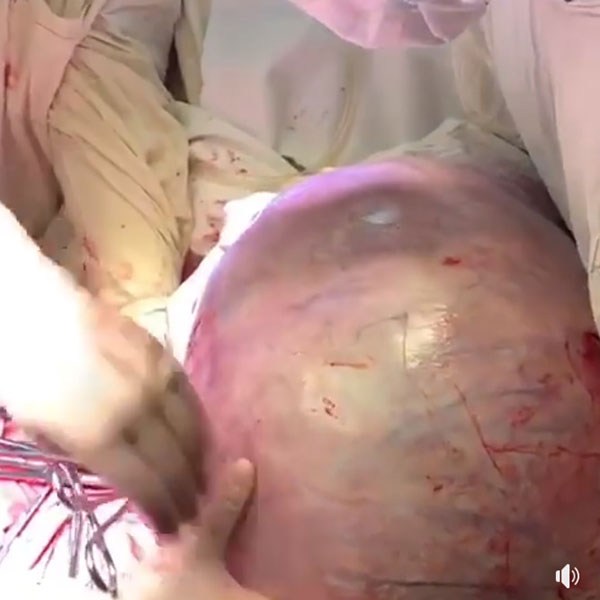 เนื้องอกยักษ์