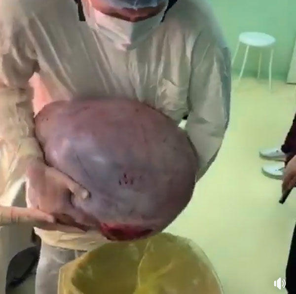 เนื้องอกยักษ์