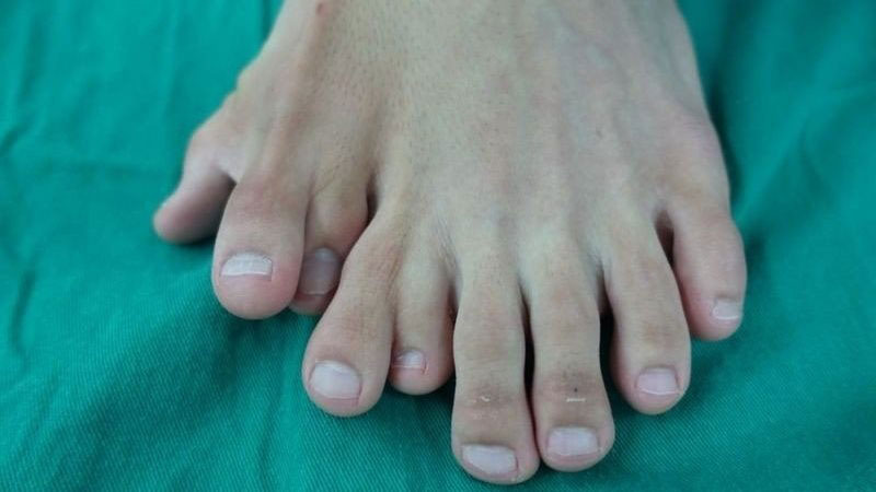 หนุ่มนิ้วเท้างอก 9 นิ้ว