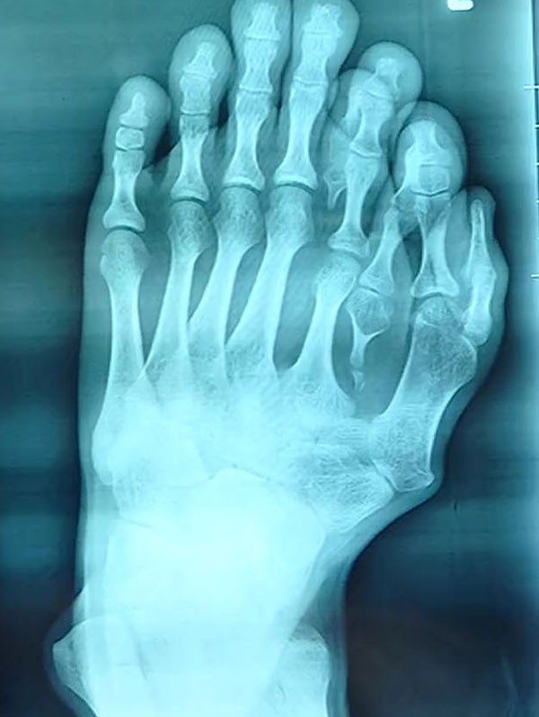 หนุ่มนิ้วเท้างอก 9 นิ้ว