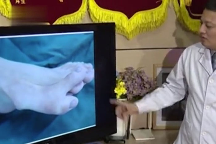 หนุ่มนิ้วเท้างอก 9 นิ้ว