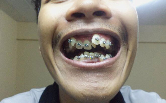 อดีตหนุ่มฟันเกระเนระนาด