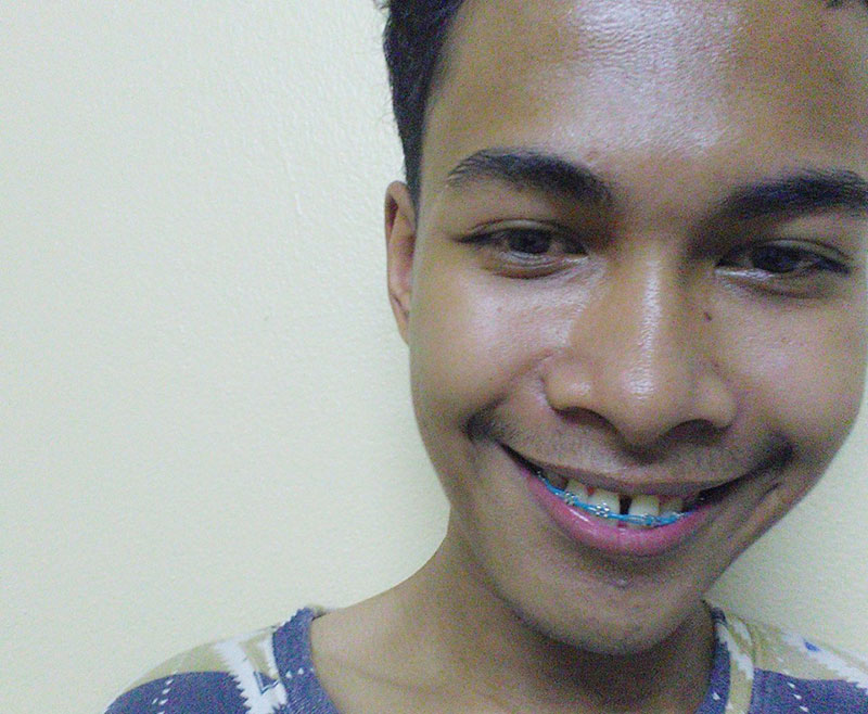 อดีตหนุ่มฟันเกระเนระนาด