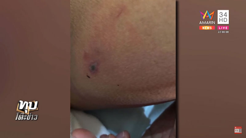 ตะขาบกัดอัณฑะ