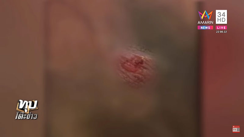 ตะขาบกัดอัณฑะ