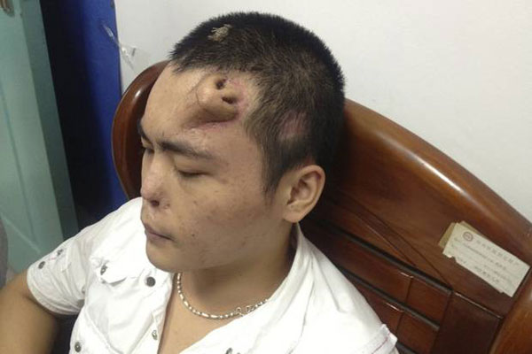 ปลูกจมูกคนไข้บนหน้าผาก