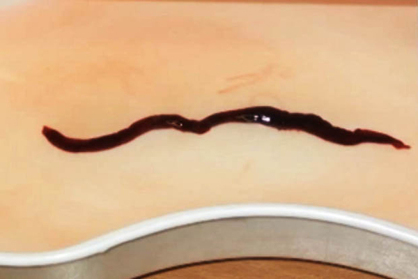 พยาธิใหญ่กัดกินไต