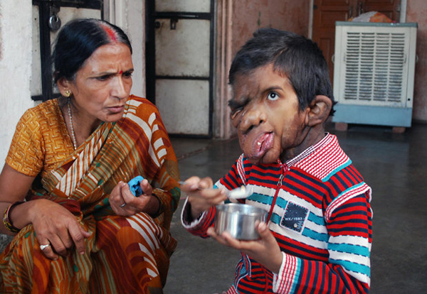 เนื้องอกลุกลาม