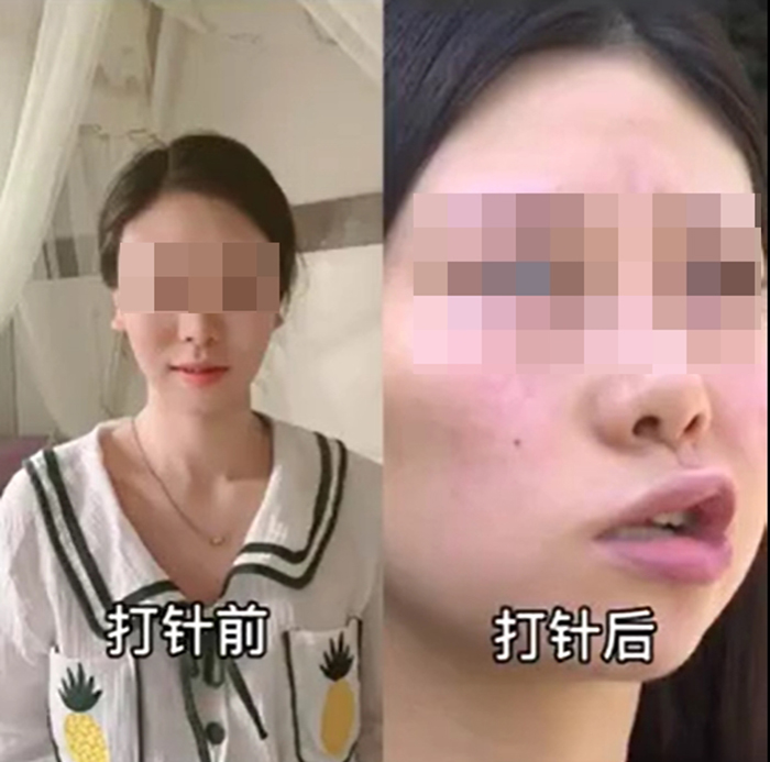 ฉีดฟิลเลอร์จนหน้าเบี้ยว