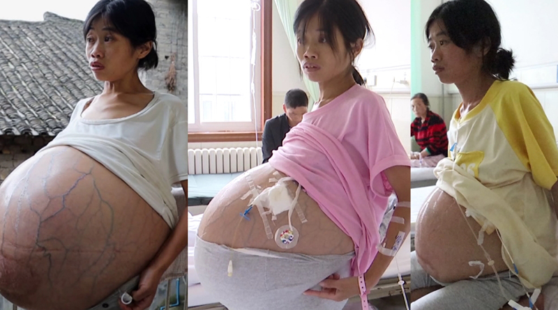 มะเร็งรังไข่