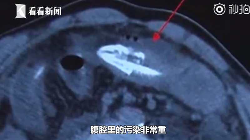 ปลาไหลเข้าก้น