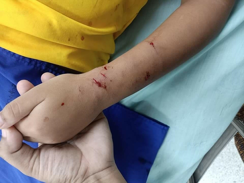 หมากัดเด็ก