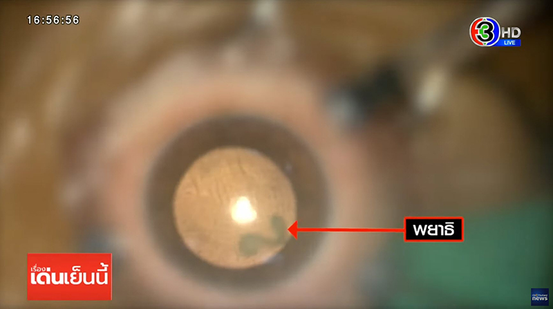 พยาธิปอดหนูขึ้นตา