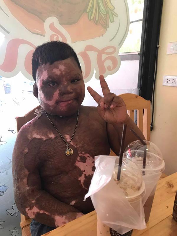 เด็กถูกไฟคลอก