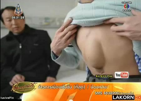 หนุ่มจีนป่วยแปลก หัวใจโผล่กลางท้อง ผ่าตัดสำเร็จแล้ว