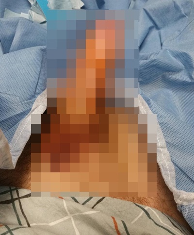 หนุ่มอยากผงาดนาน ฉีดยาโด๊ปเข้านกเขา เจ้าโลกบวมเป่งแทบระเบิด