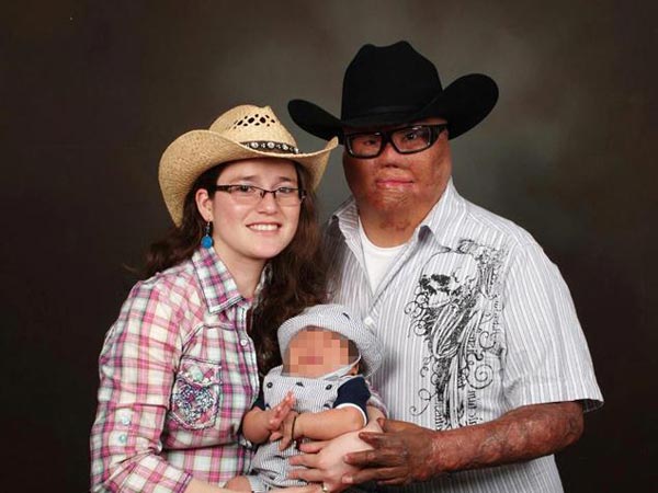 ทหารมะกันเคราะห์ร้าย ถูกระเบิดหน้าเละ-แขนขาด แต่โชคดีพบรักแท้