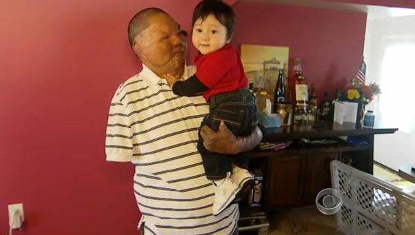 ทหารมะกันเคราะห์ร้าย ถูกระเบิดหน้าเละ-แขนขาด แต่โชคดีพบรักแท้