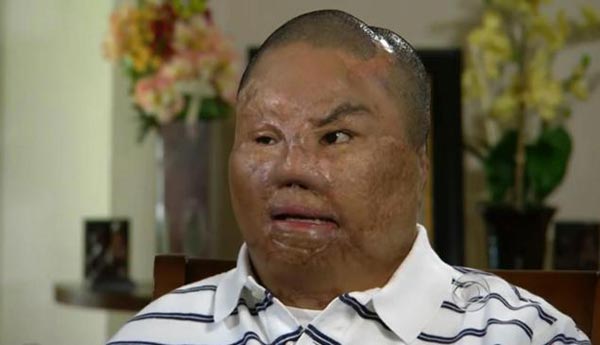 ทหารมะกันเคราะห์ร้าย ถูกระเบิดหน้าเละ-แขนขาด แต่โชคดีพบรักแท้