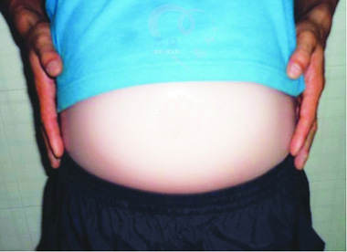 ซิลิโคนท้อง หลอกว่าตั้งครรภ์