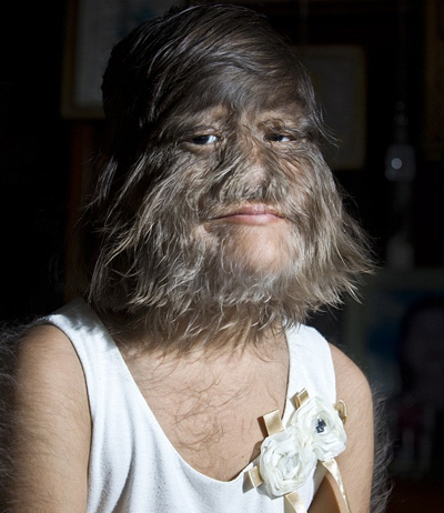 เด็กหญิงที่มีขนยาวที่สุดในโลก